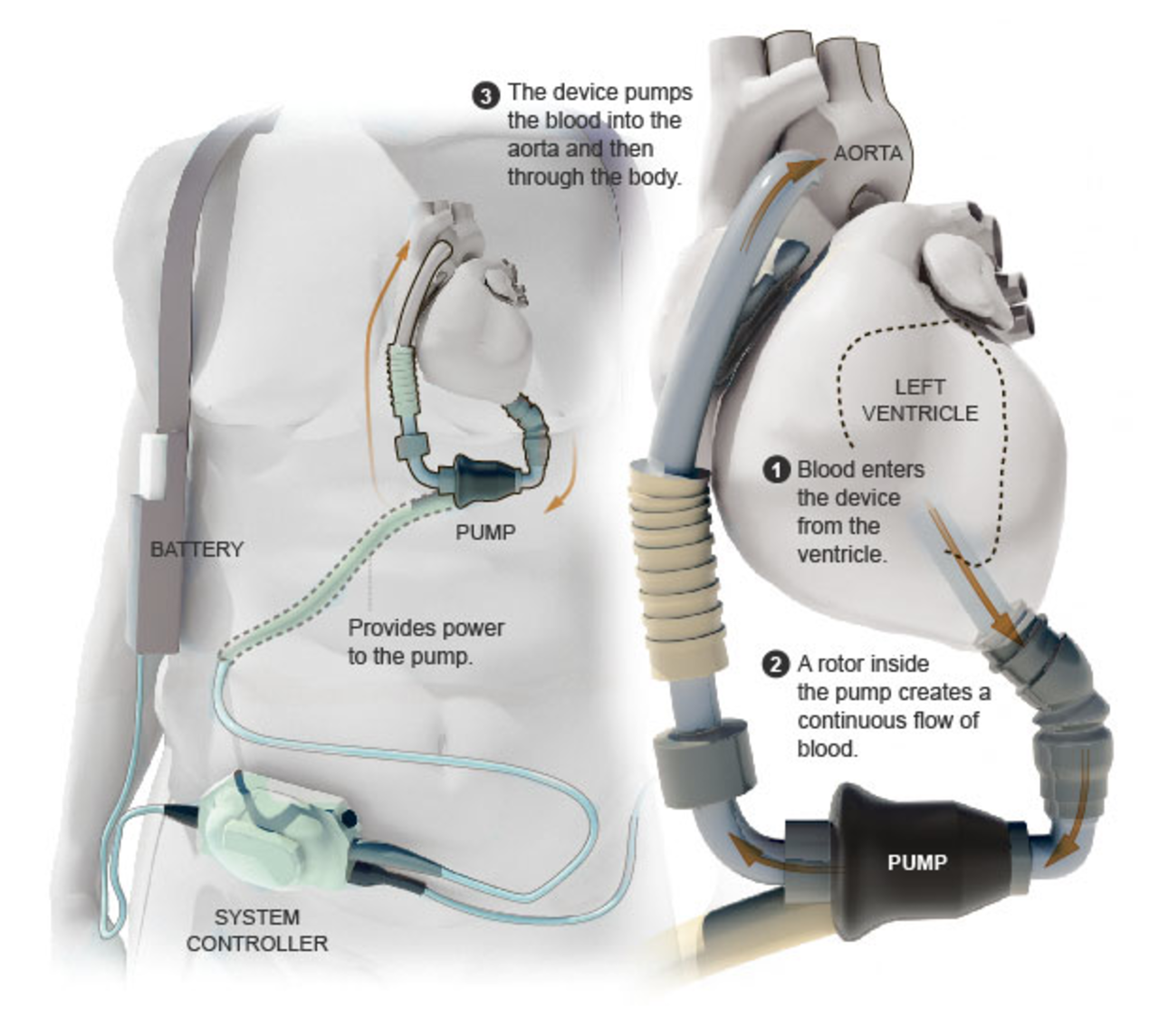 Dick Cheney har ingen puls