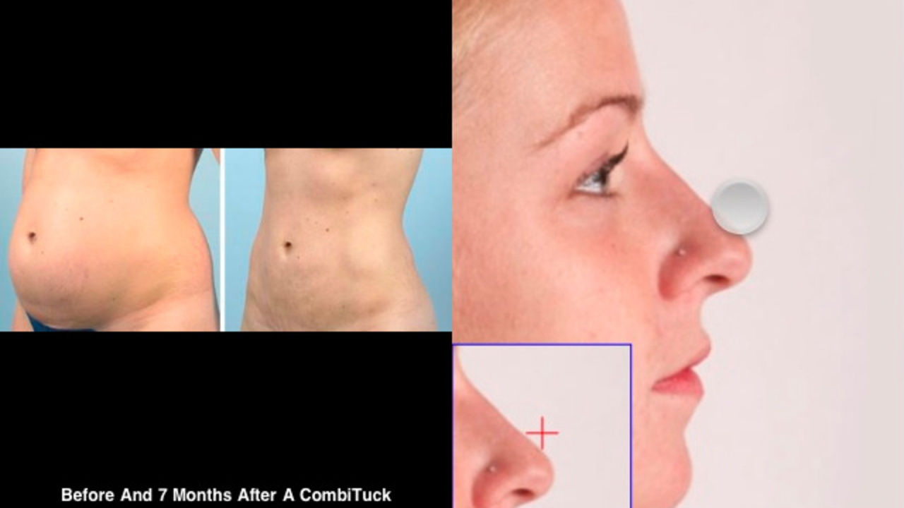 App visar hur du skulle se ut efter plastikoperation