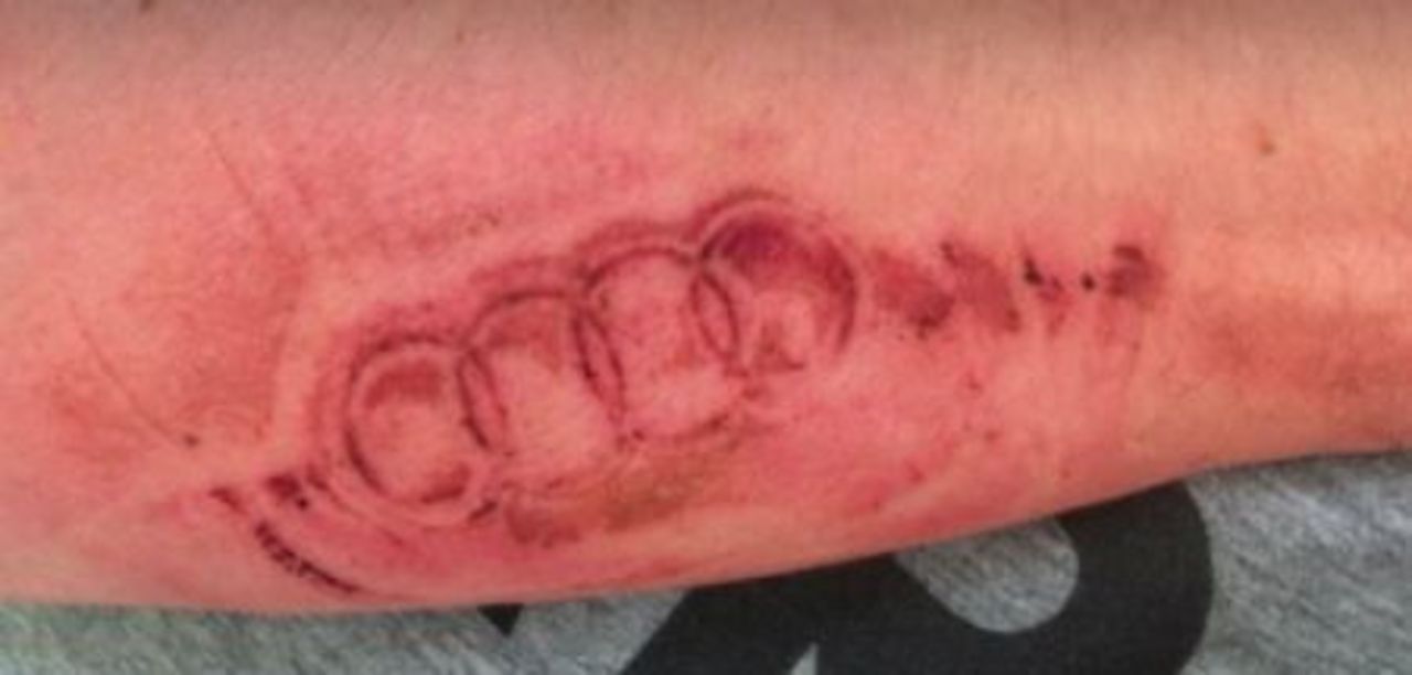 Airbag gav snubbe tillfällig tatuering på armen