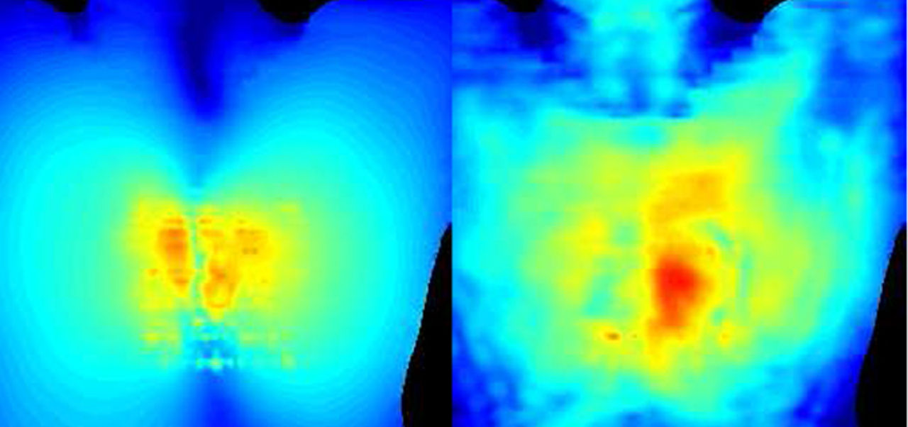 Forskare har lyckats driva ett hjärtimplantat med radiovågor