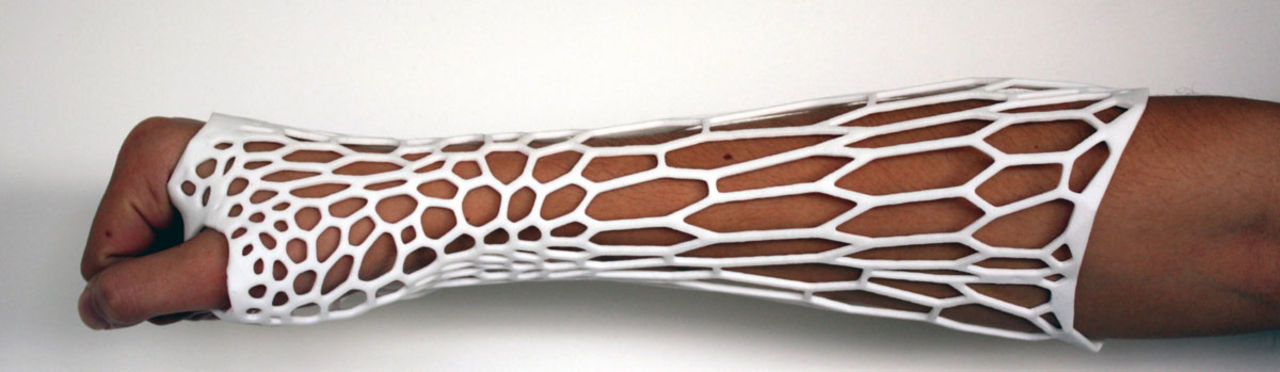 3D-utskrifter kan ersätta gips-bandage