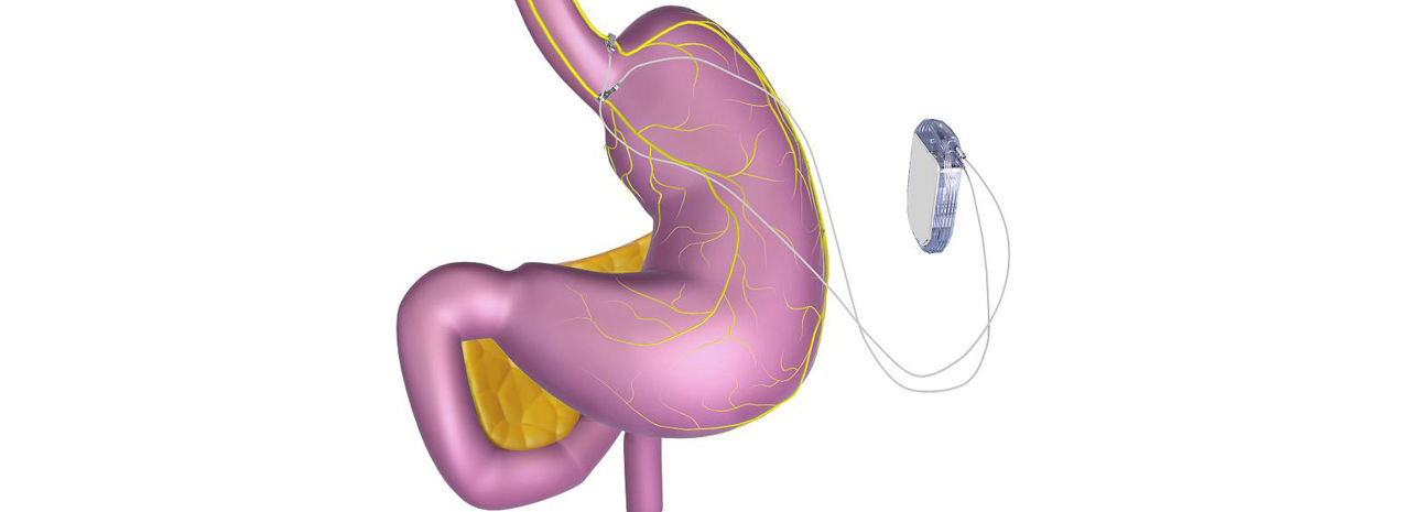 Pacemaker för magen