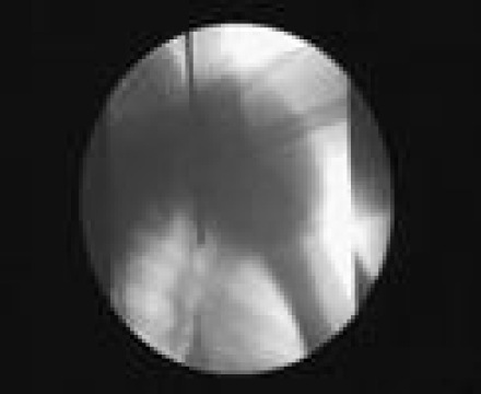 Tumnagel