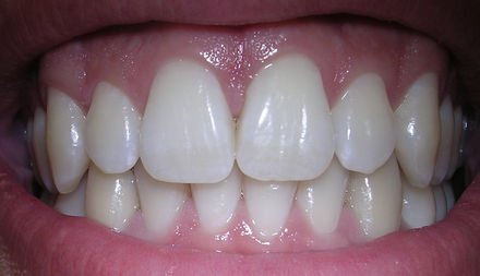 Tumnagel