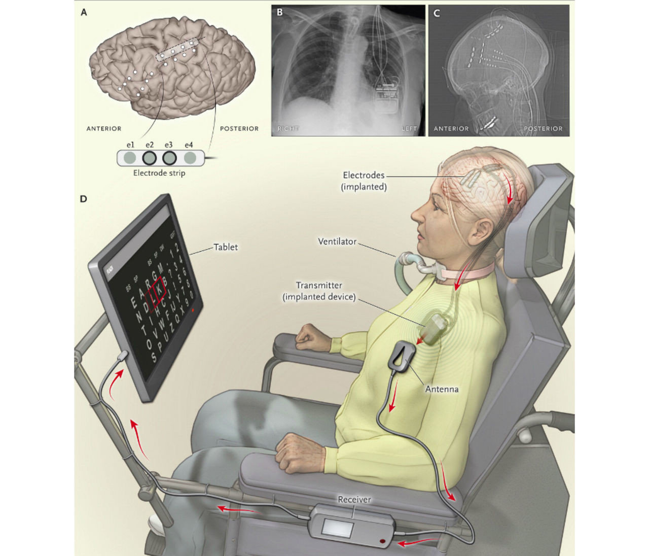 Implantat i hjärnan ger förlamad kvinna mer frihet