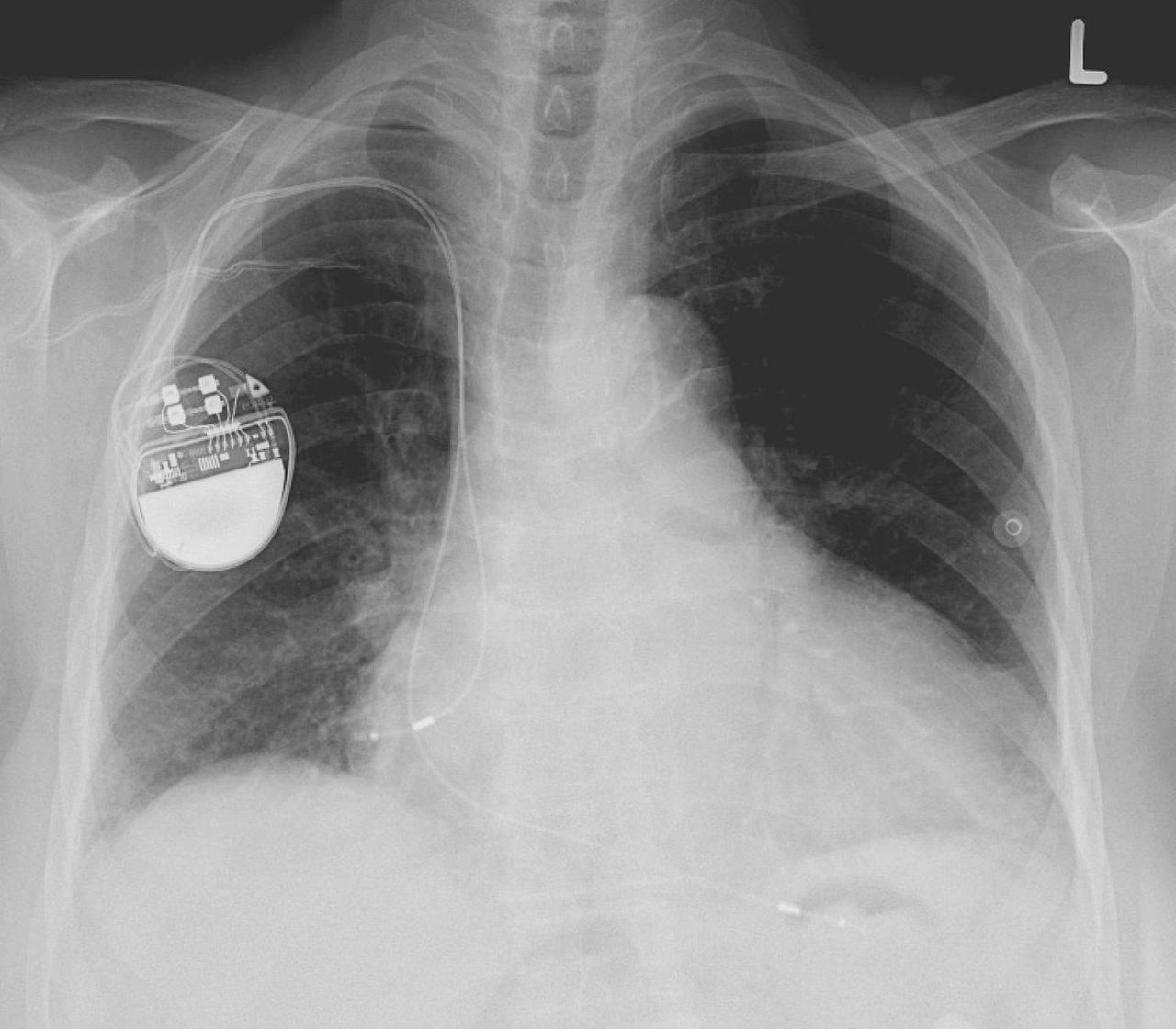 Pacemaker satte dit snubbe för mordbrand