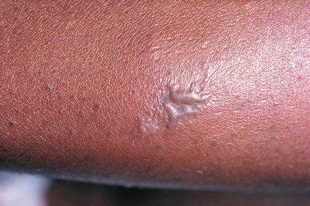 Tumnagel