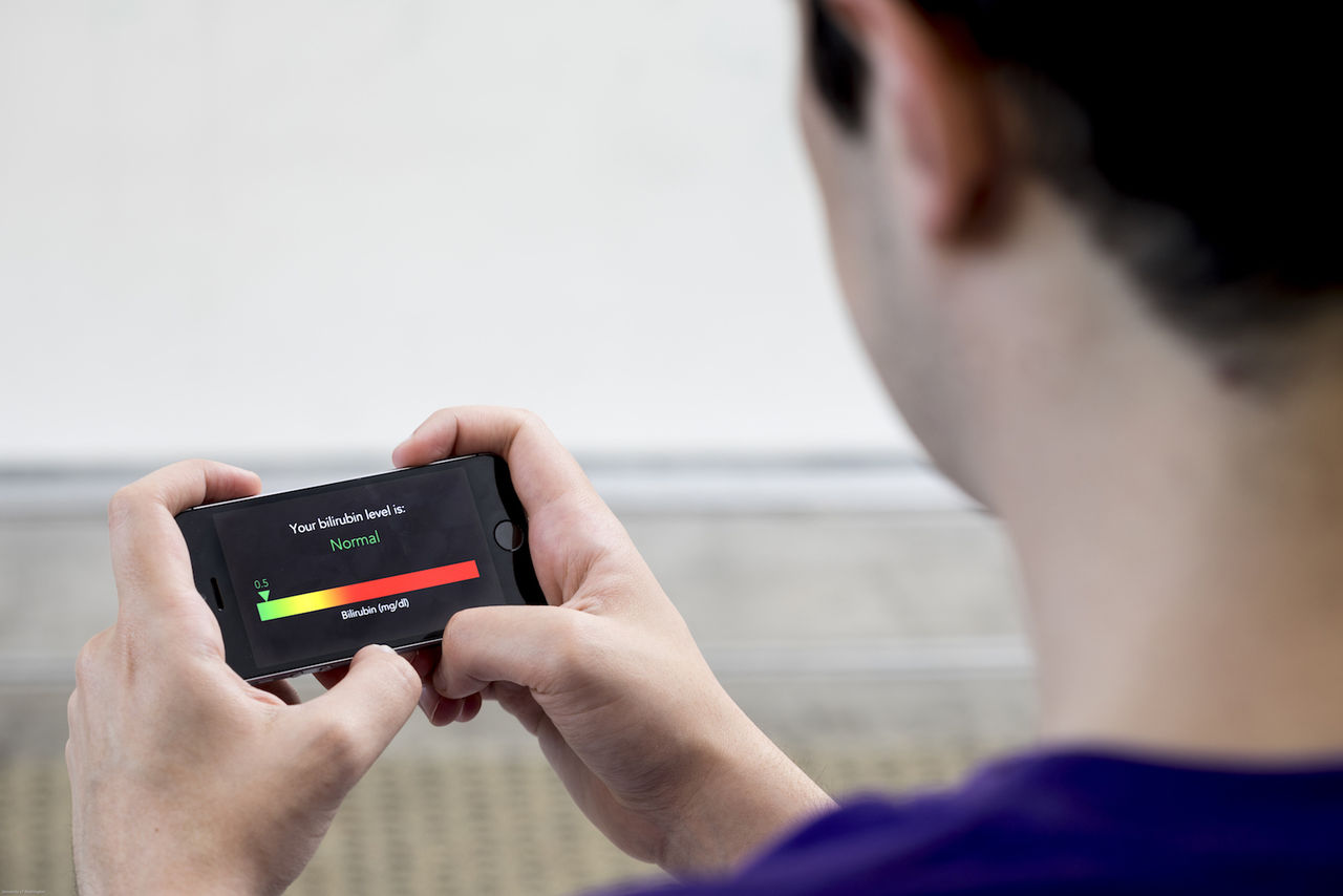 BiliScreen kan upptäcka cancer i bukspottskörteln