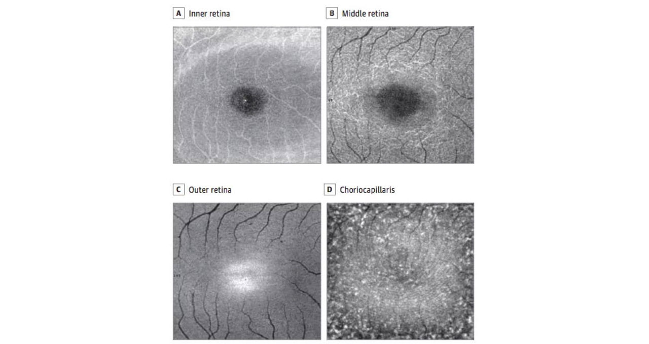 Bästa bilderna på ett solskadat öga hittills