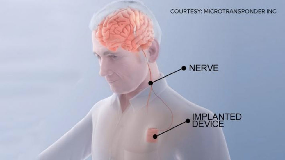 Pacemaker för hjärnan kan få strokepatienter att tillfriskna snabbare