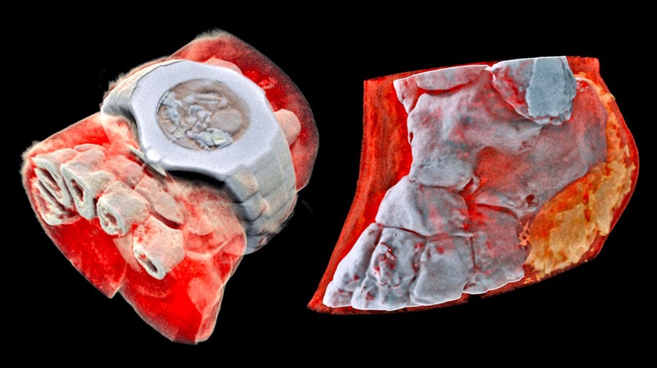 Här är världens första röntgenbild i färg på en människa