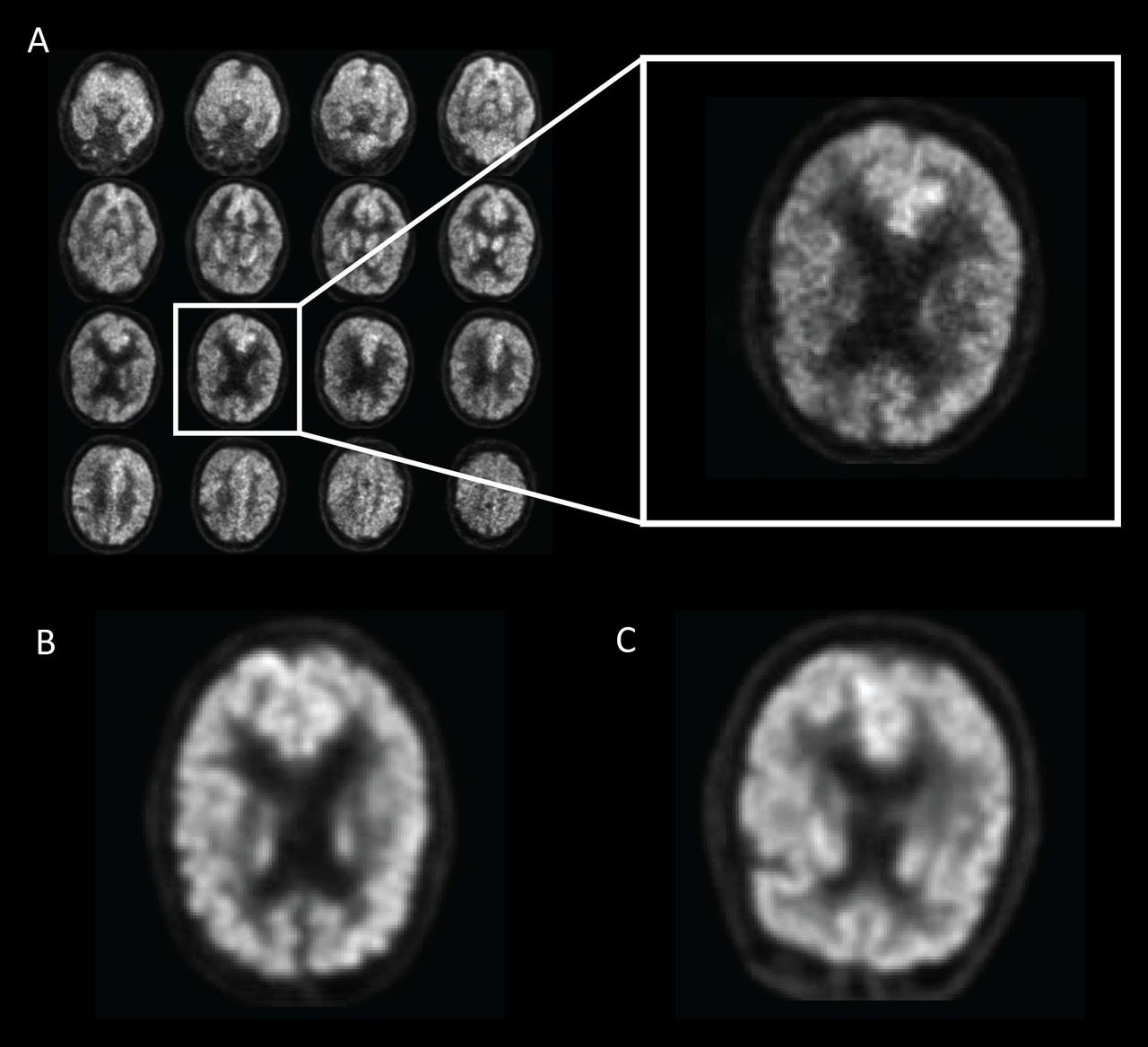 AI kan upptäcka Alzheimers innan den brutit ut