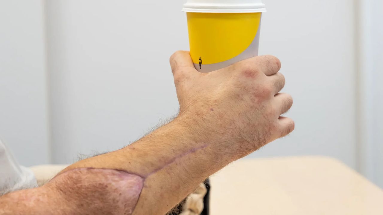 Dubbel handtransplantation genomförd på Södersjukhuset