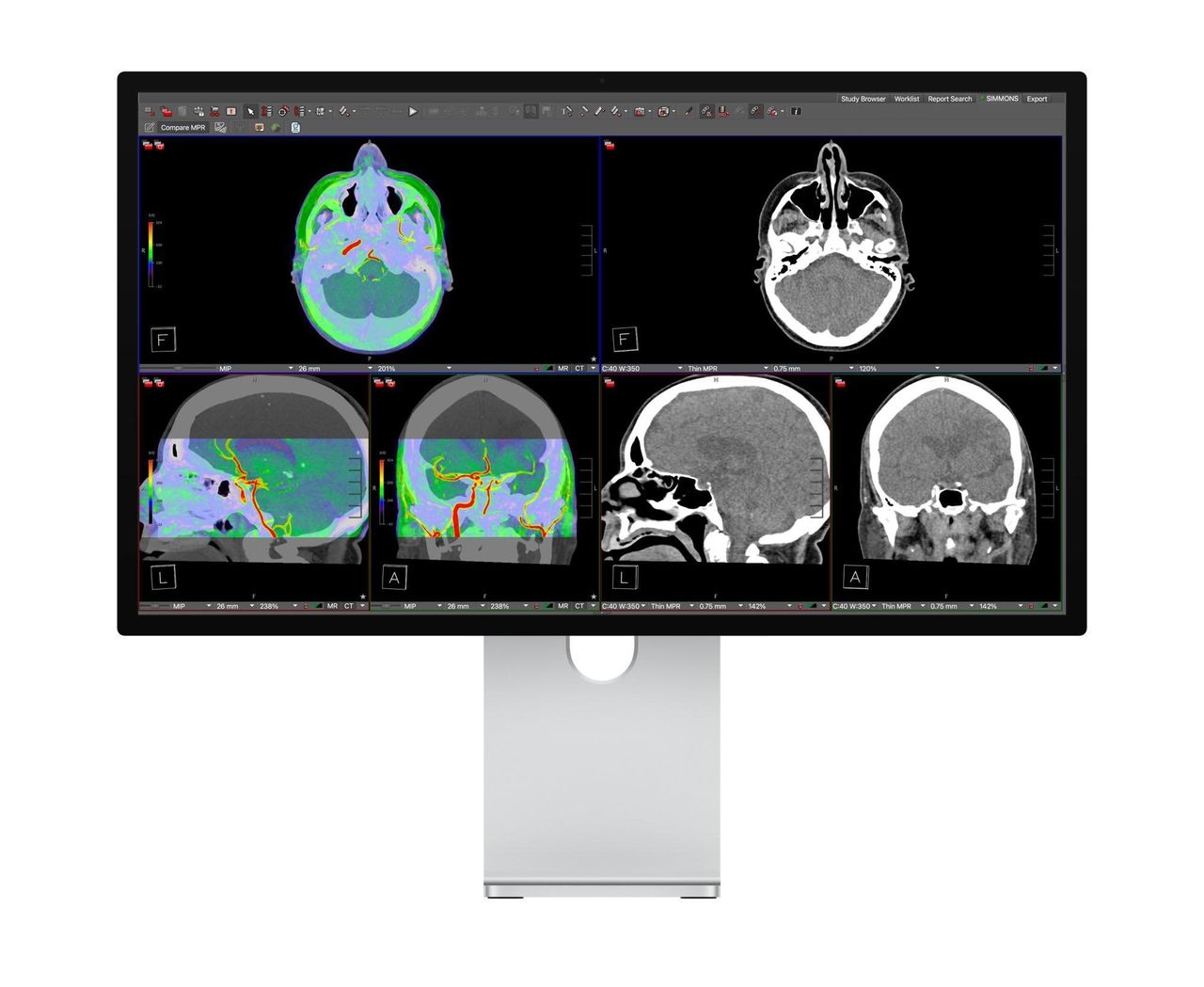 Apples Studio Display XDR blir medicinskt godkänd