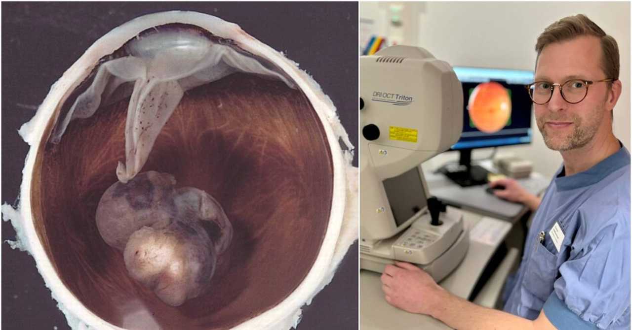 Nytt AI-verktyg ska hitta aggressiv ögoncancer