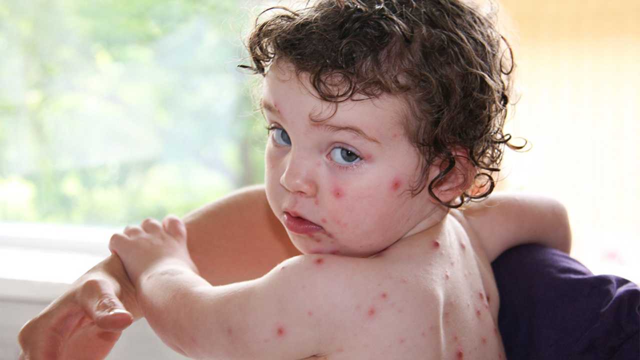 RS-virus och vattkoppor blir anmälningspliktiga